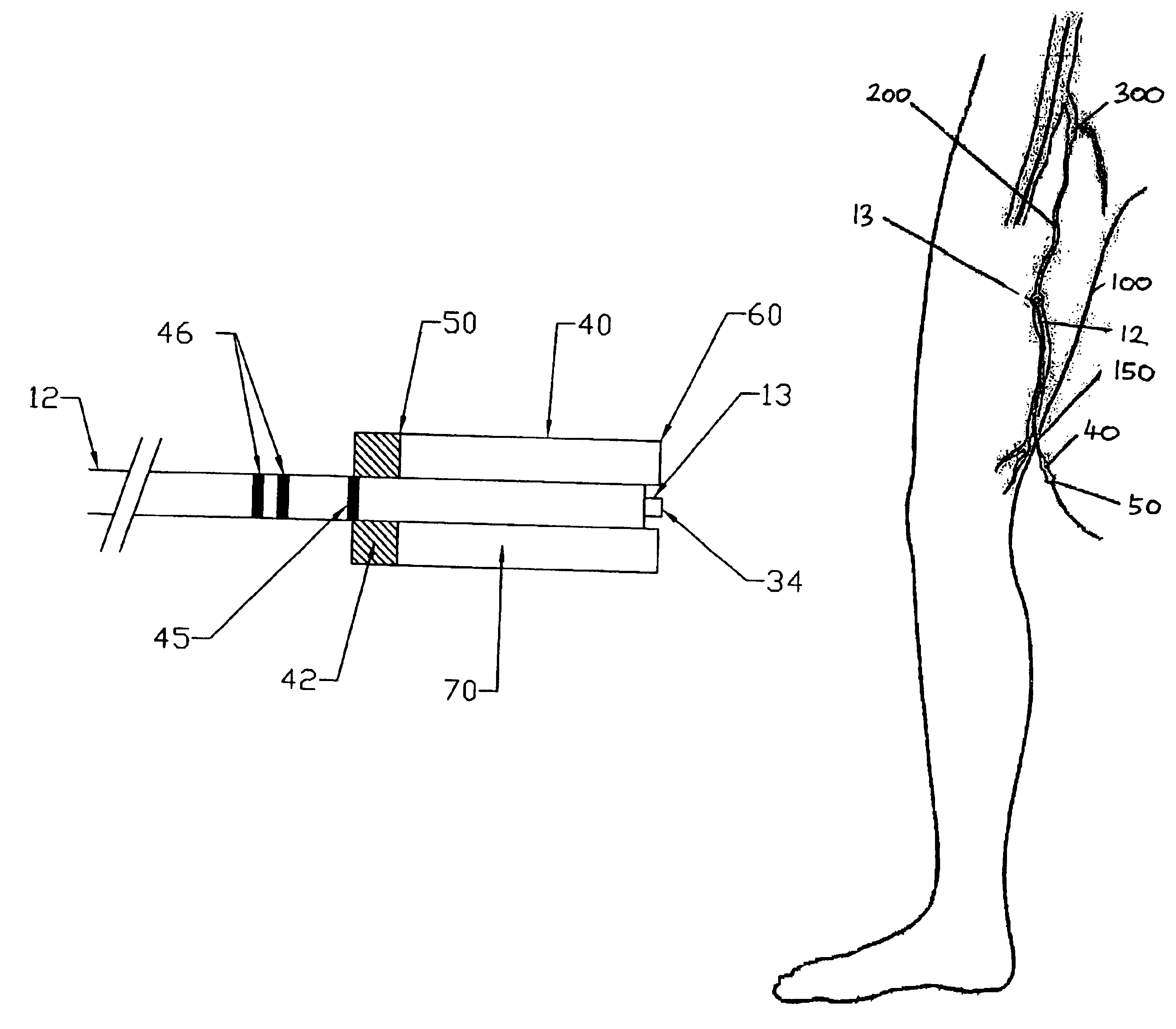 Method of endovenous laser treatment