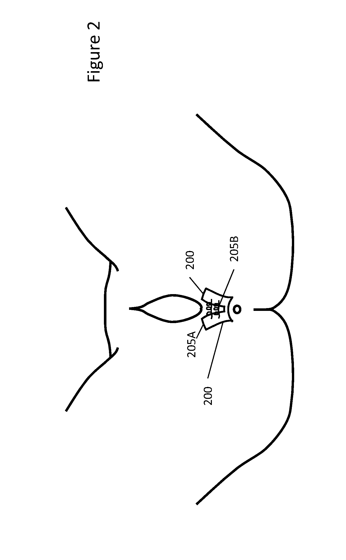 Device and Methods to Reduce Vaginal Tearing During Delivery