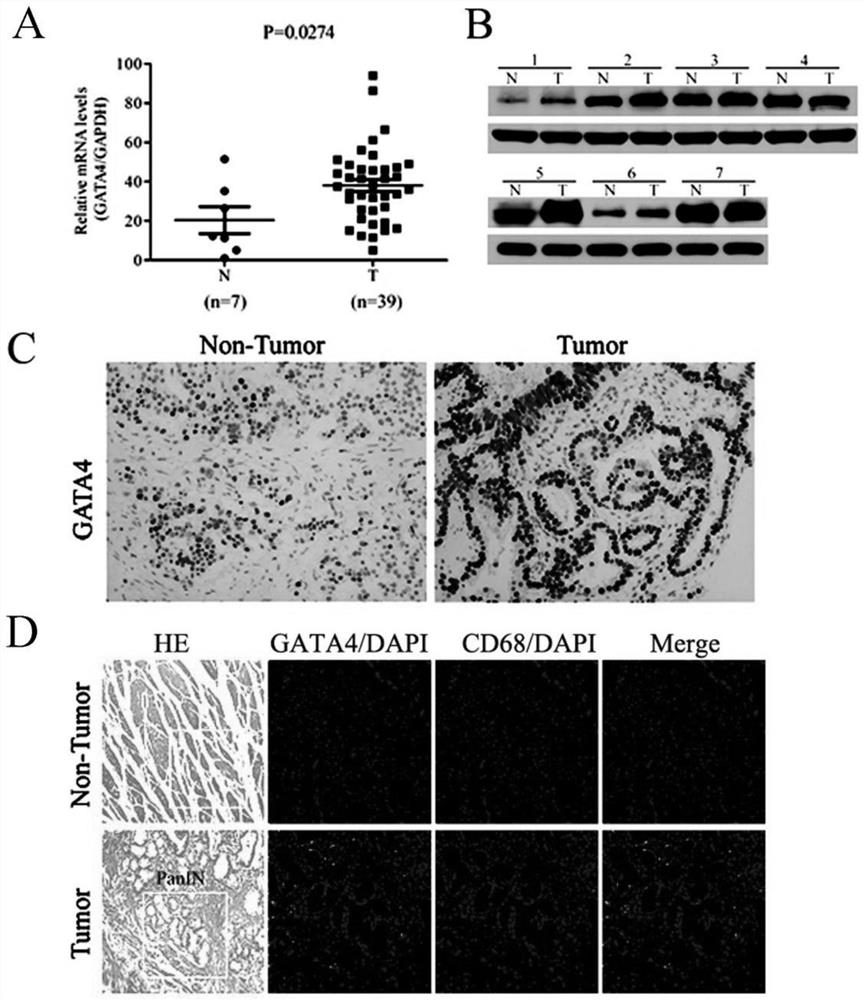 Application of diagnostic marker GATA4 in pancreas inflammatory cancer transformation