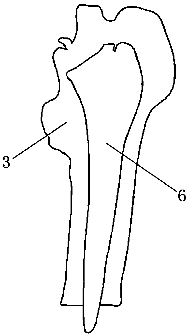 Personal guide device of implanting anteversion angle for femoral stem prosthesis