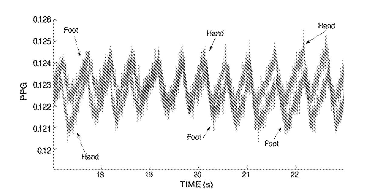 Detection of patent ductus arteriosus using photoplethysmography