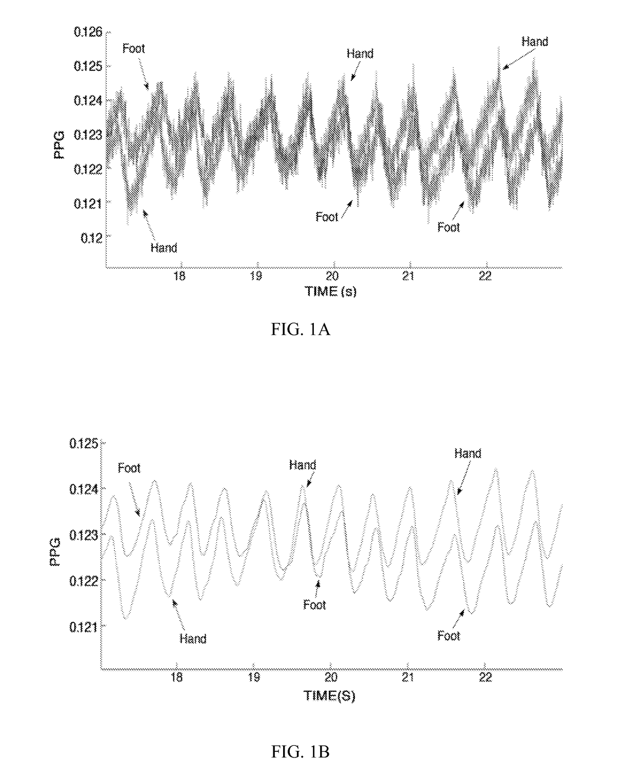 Detection of patent ductus arteriosus using photoplethysmography