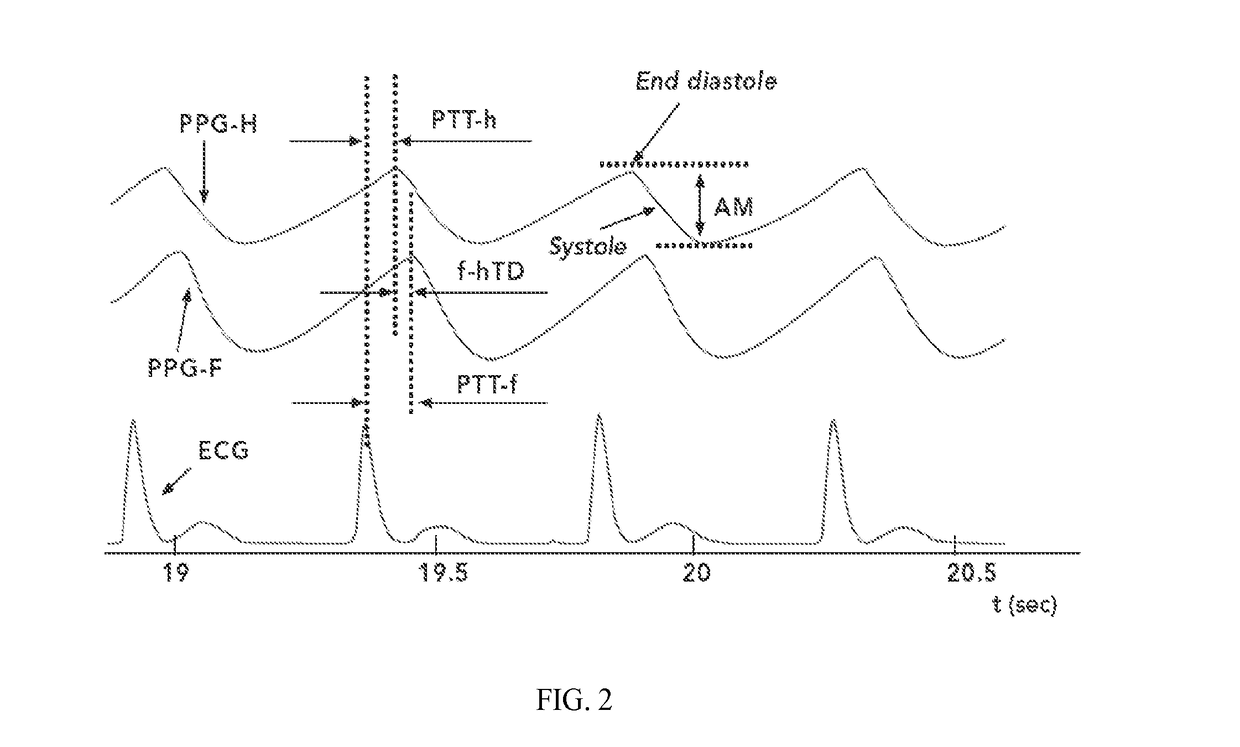 Detection of patent ductus arteriosus using photoplethysmography