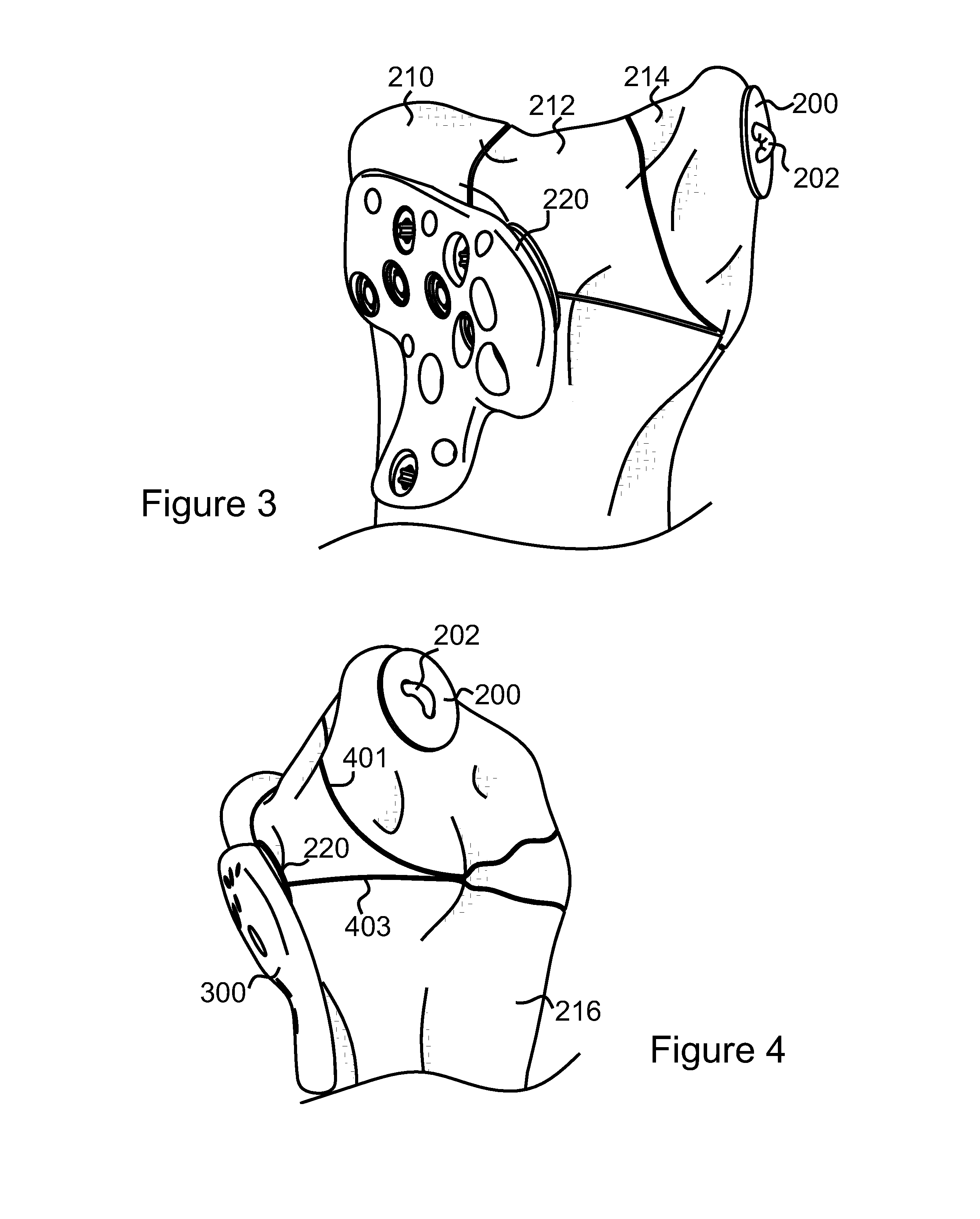 Atraumatic fastener and bone stabilization system and method of use