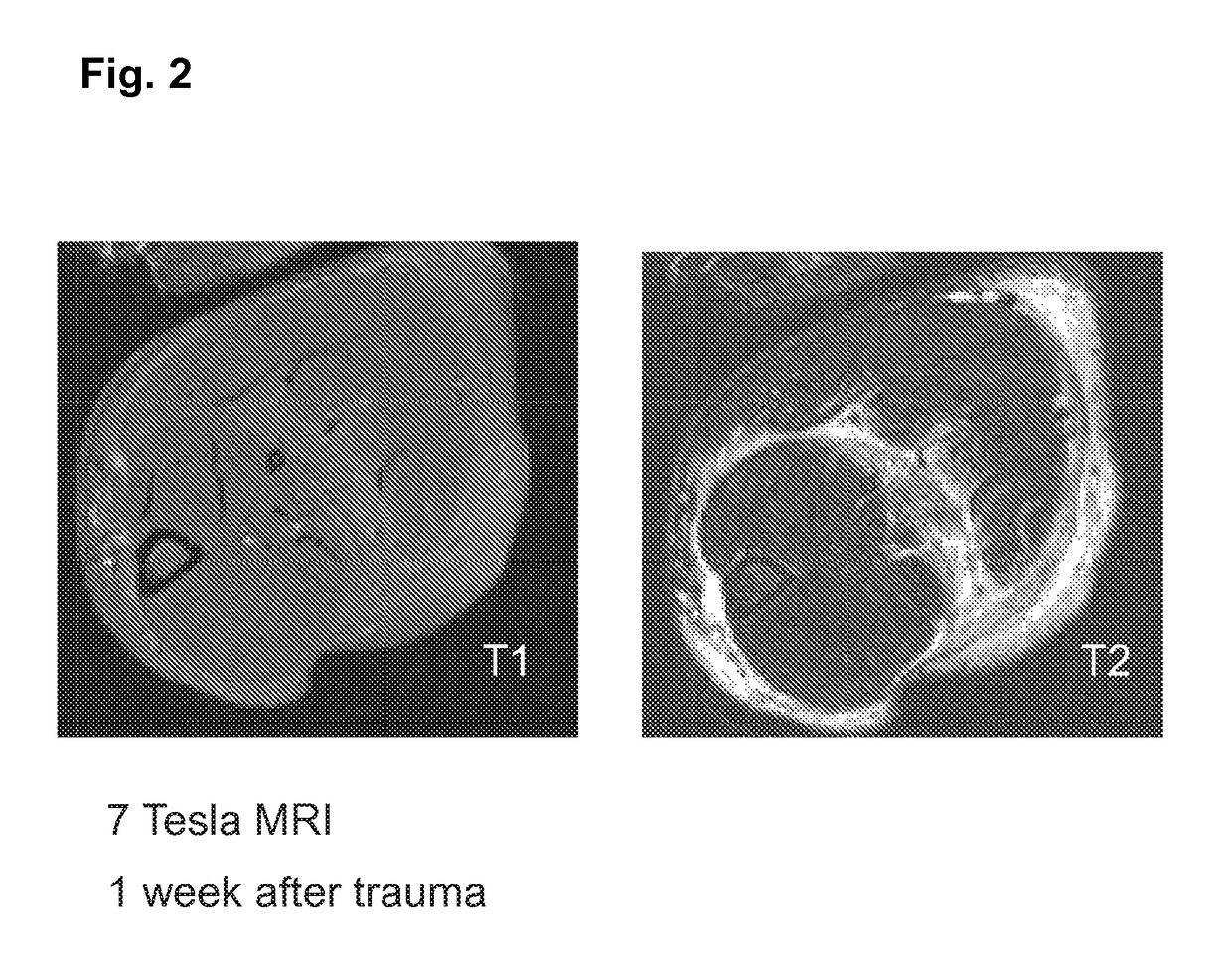 Skeletal muscle regeneration using mesenchymal system cells