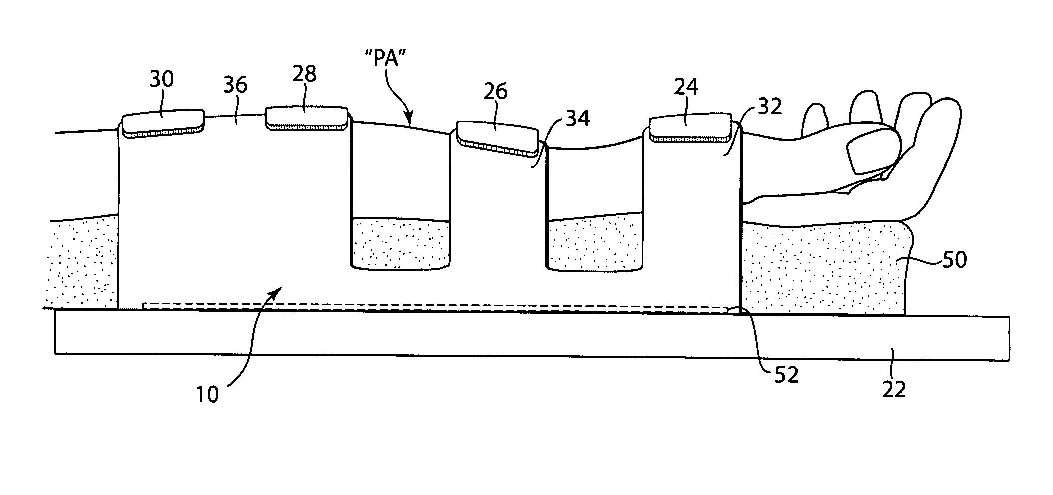 Arm board patient securement arrangement