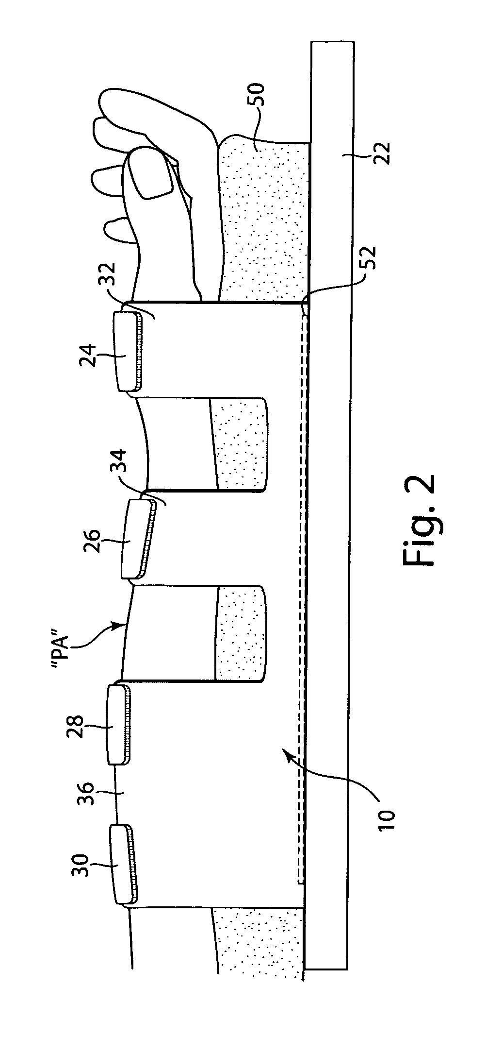 Arm board patient securement arrangement