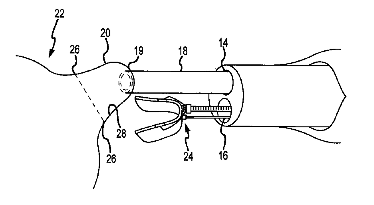 System for occlusion of left atrial appendage