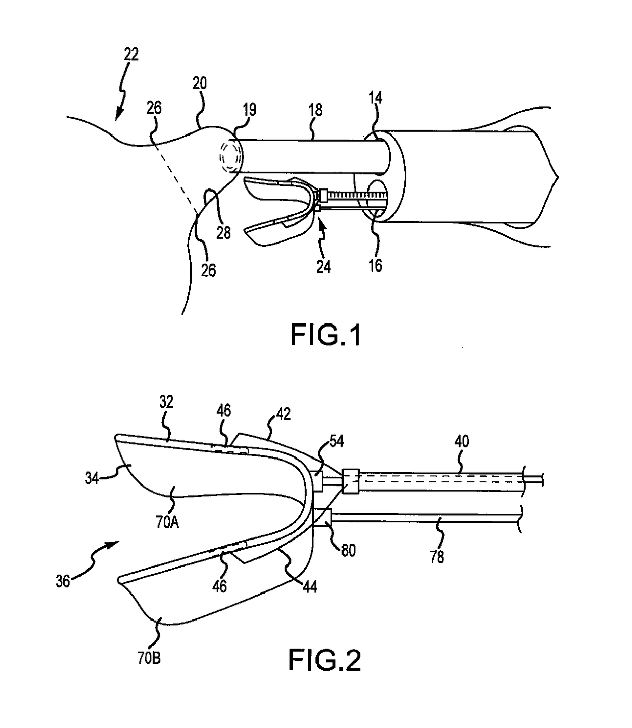 System for occlusion of left atrial appendage