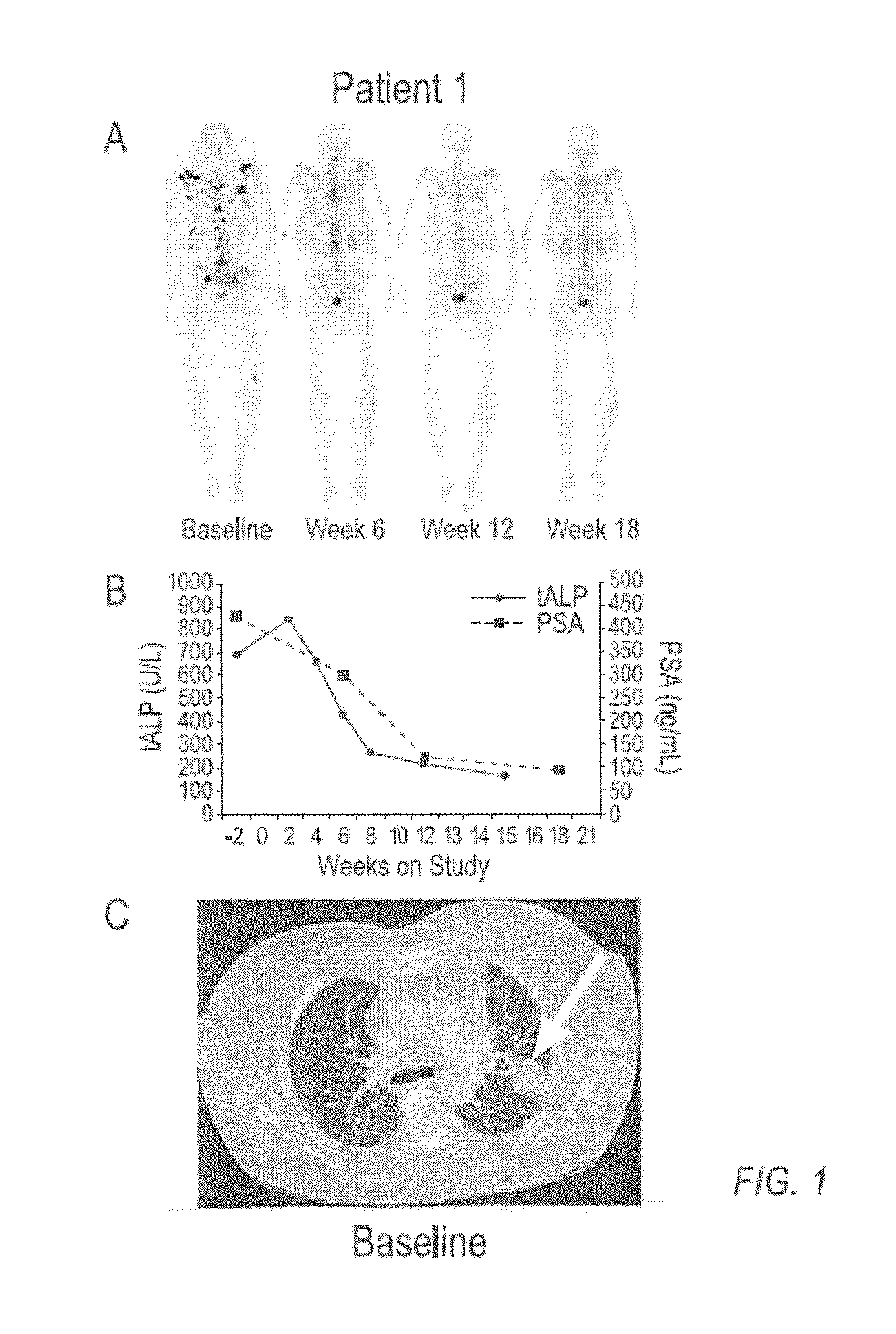 Method of Treating Cancer and Bone Cancer Pain