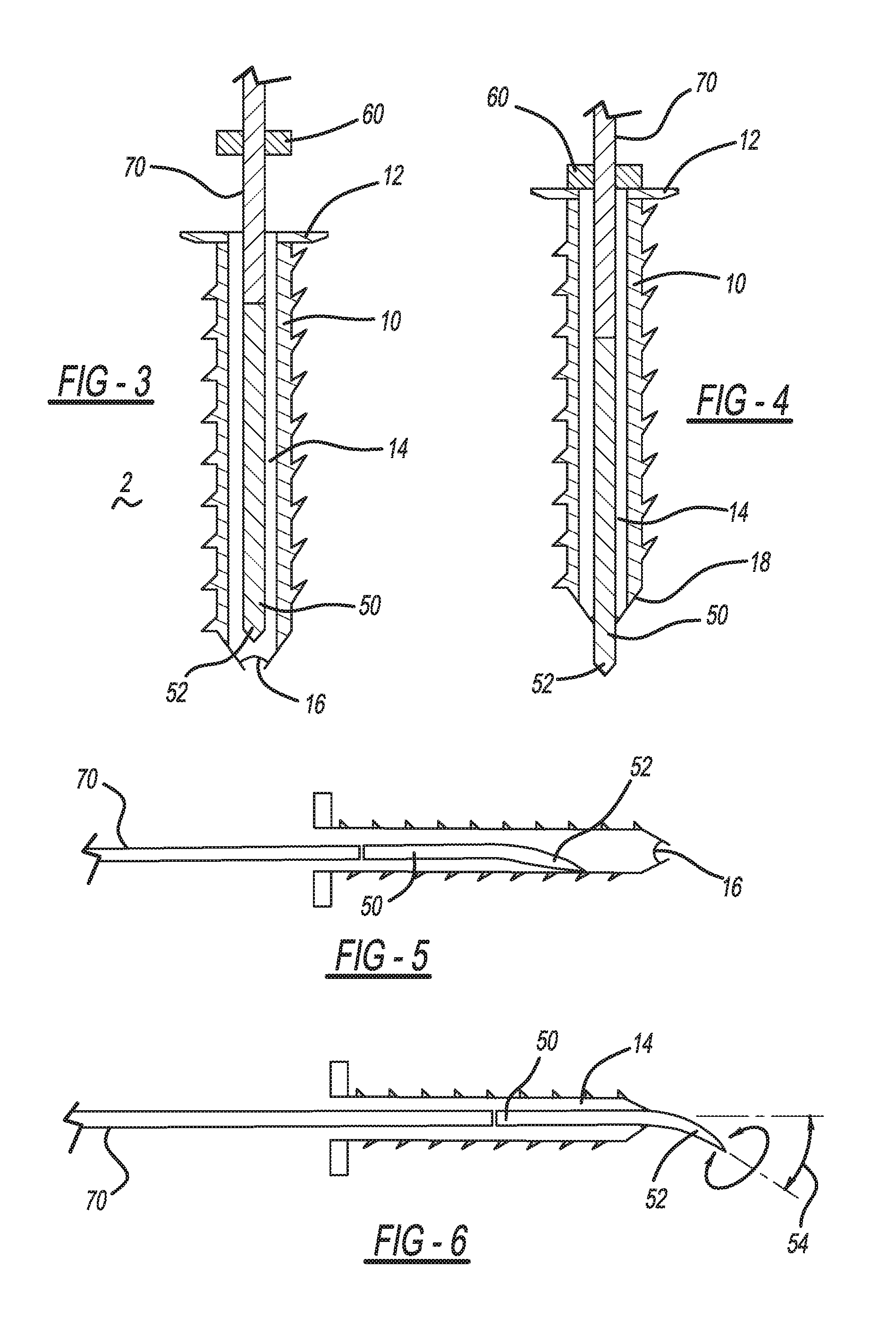 Retractable screw guide