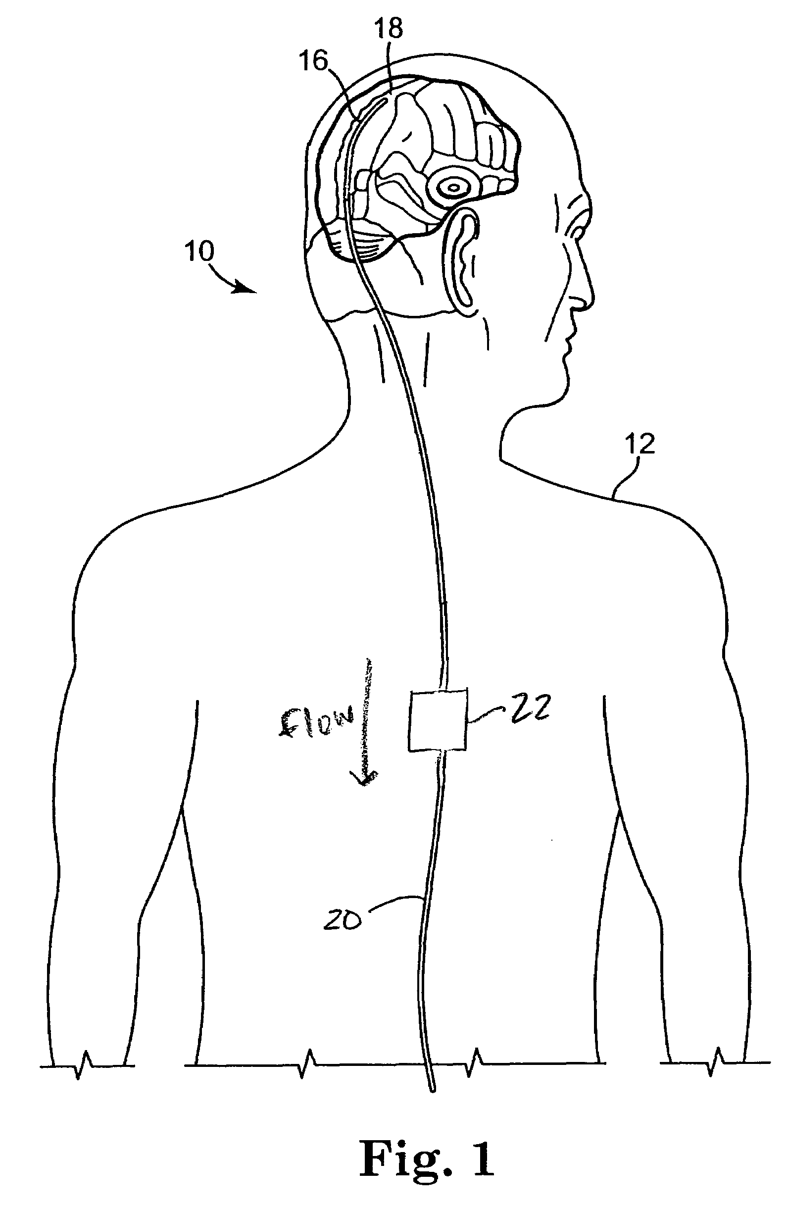 Implantable cerebral spinal fluid drainage device and method of draining cerebral spinal fluid