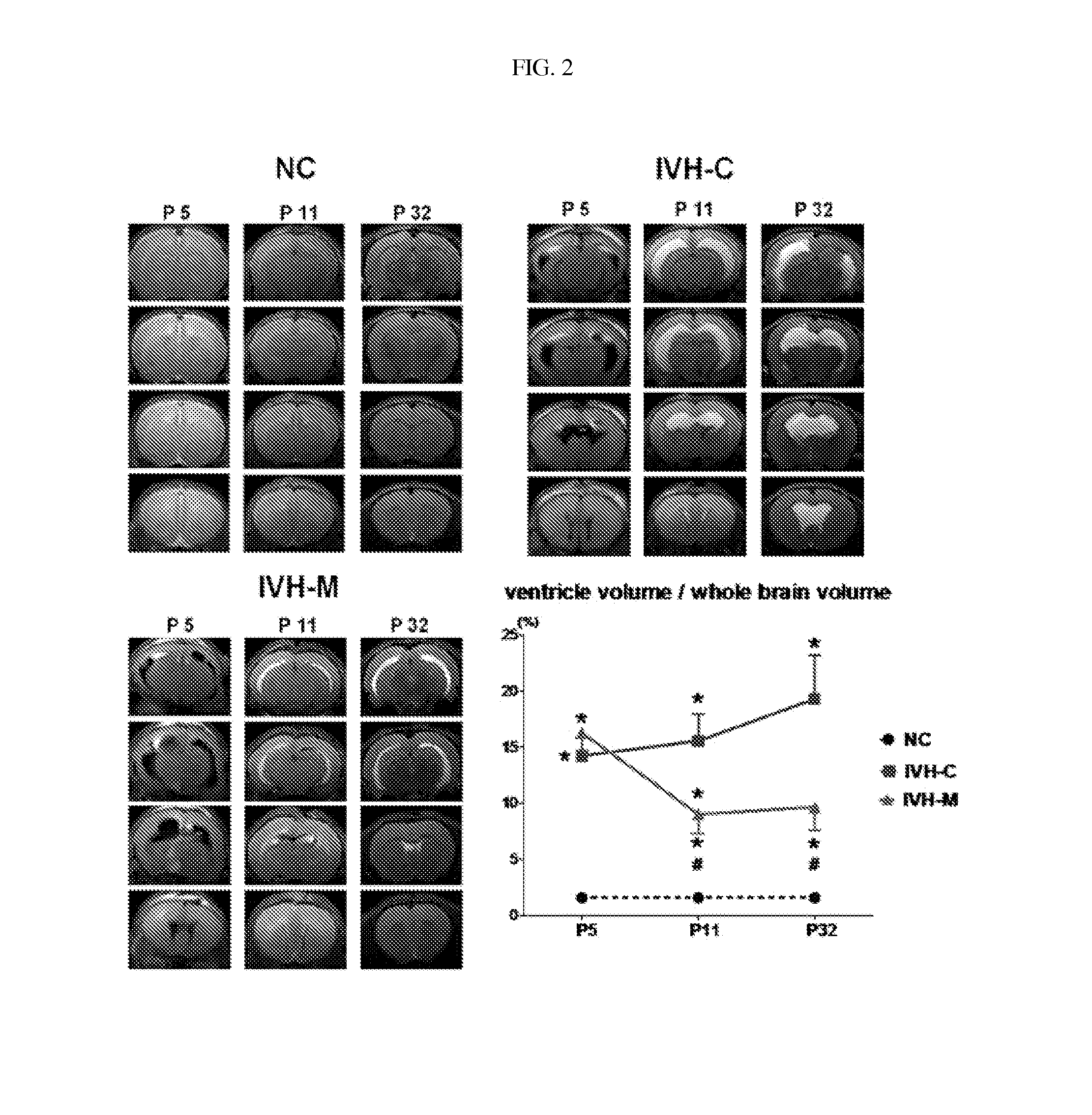 Composition for treating intraventricular hemorrhage in preterm infants comprising mesenchymal stem cells