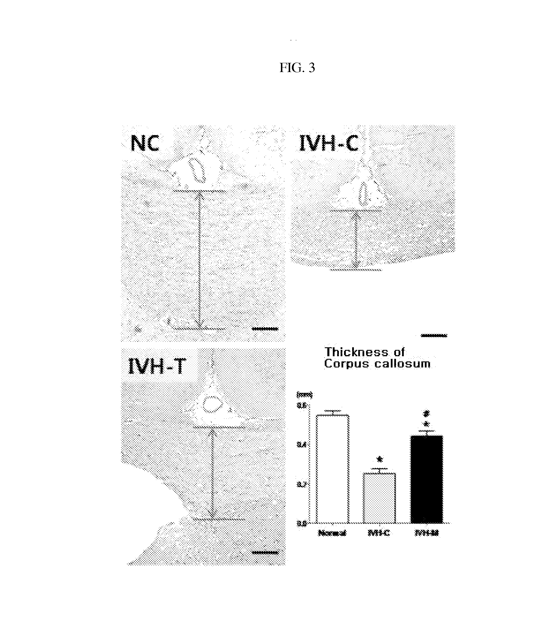 Composition for treating intraventricular hemorrhage in preterm infants comprising mesenchymal stem cells