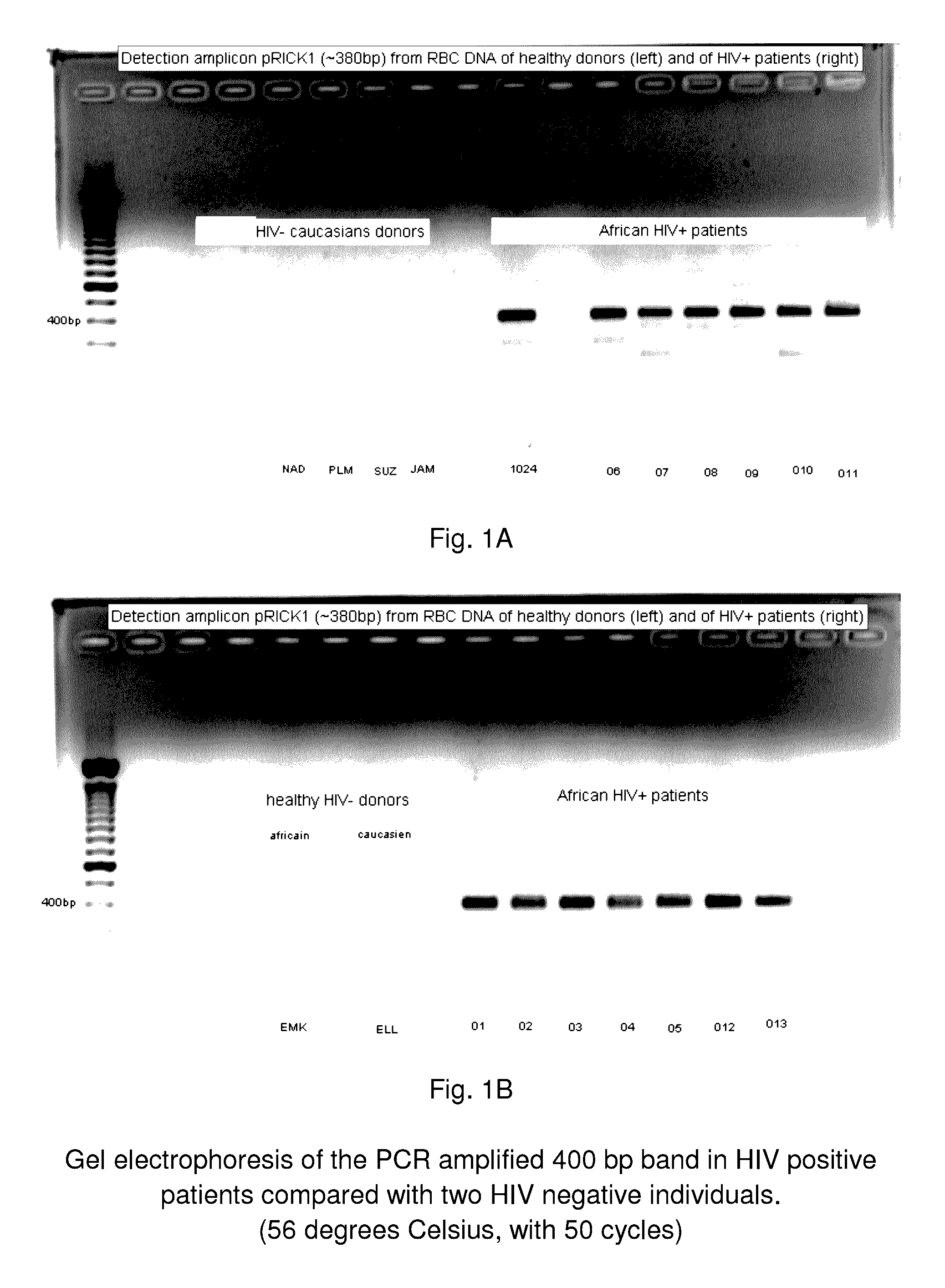 System and method for the detection and treatment of infection by a microbial agent associated with HIV infection