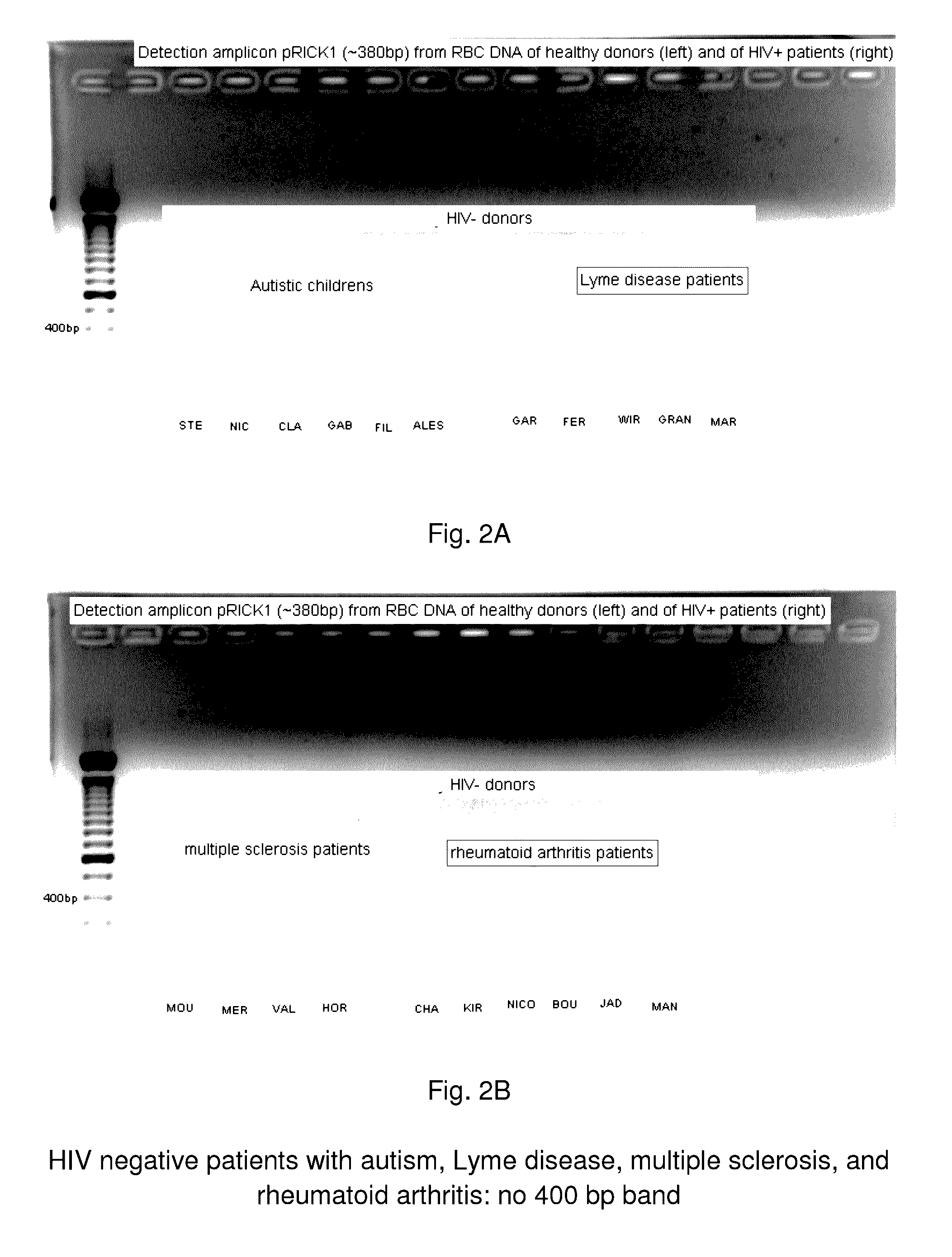 System and method for the detection and treatment of infection by a microbial agent associated with HIV infection