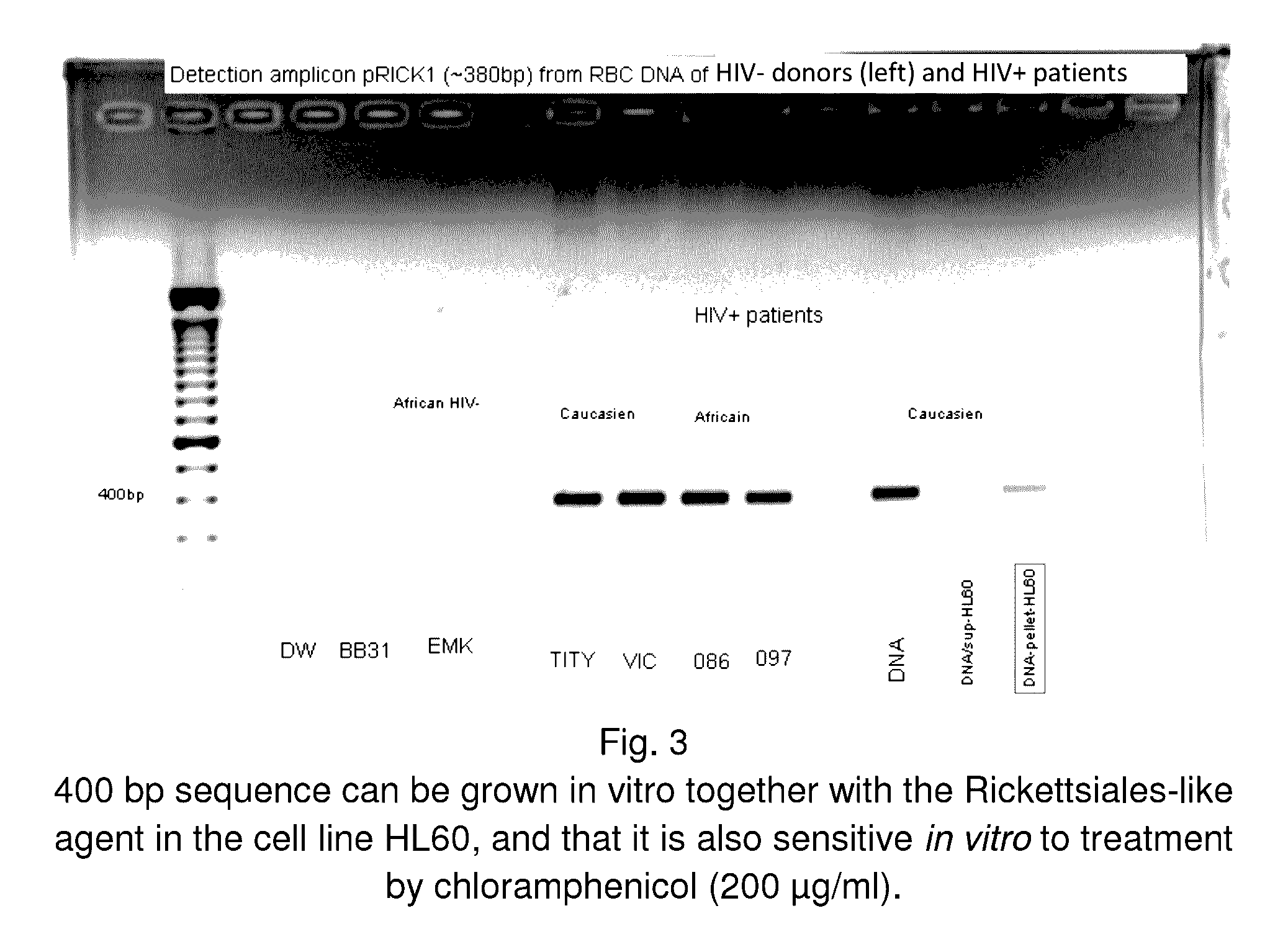 System and method for the detection and treatment of infection by a microbial agent associated with HIV infection