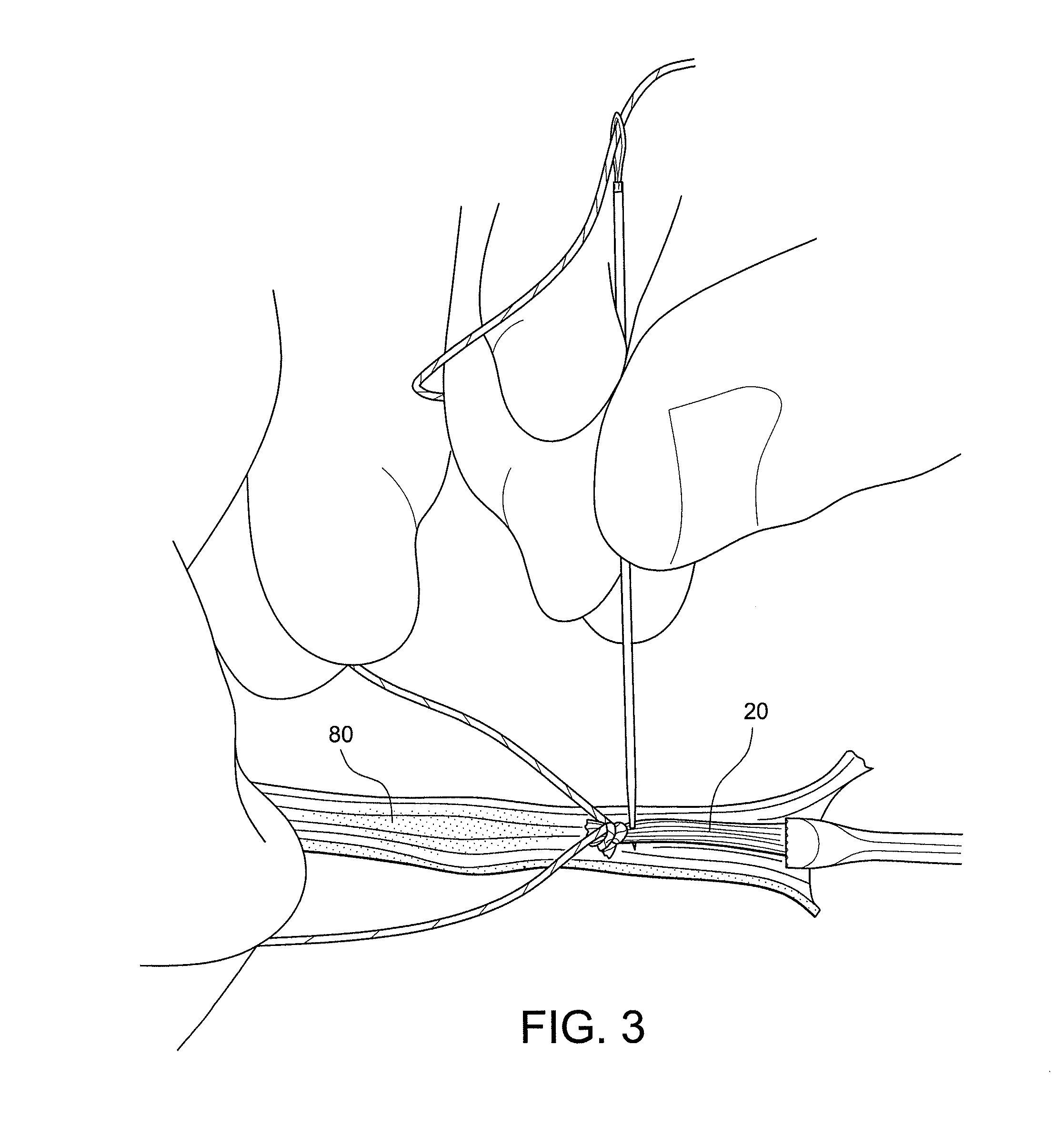 Methods of making reinforced soft grafts with suture loop/needle construct