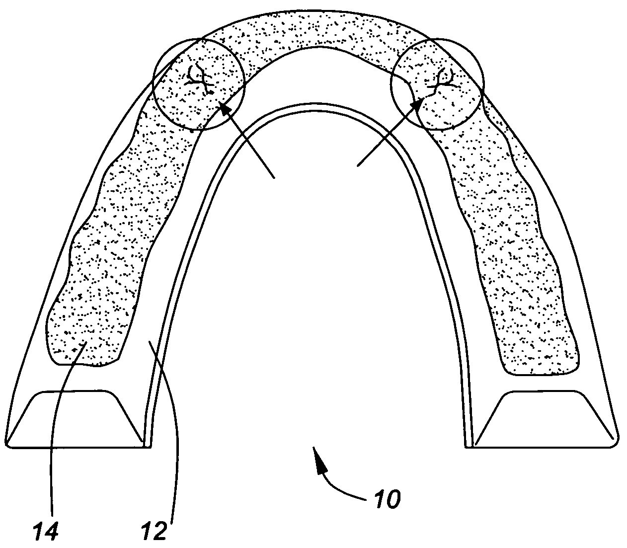 Bruxism appliance and method of forming