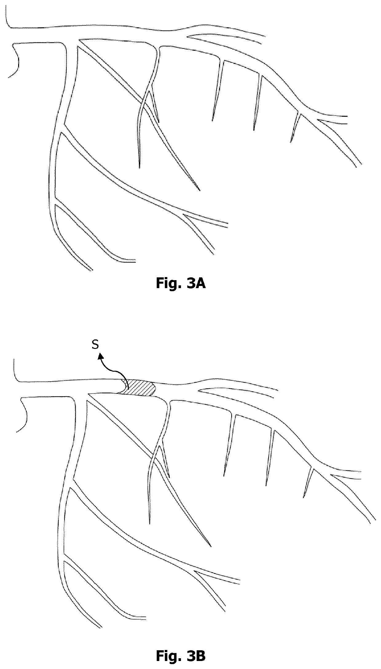 Controlled pressure reperfusion catheter