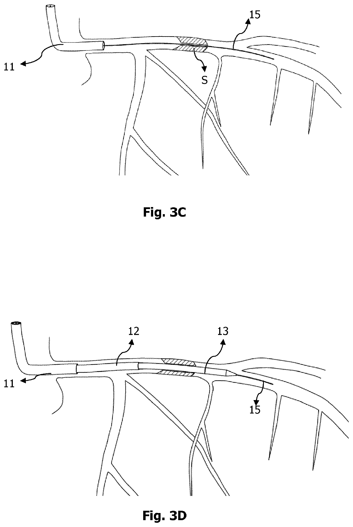 Controlled pressure reperfusion catheter