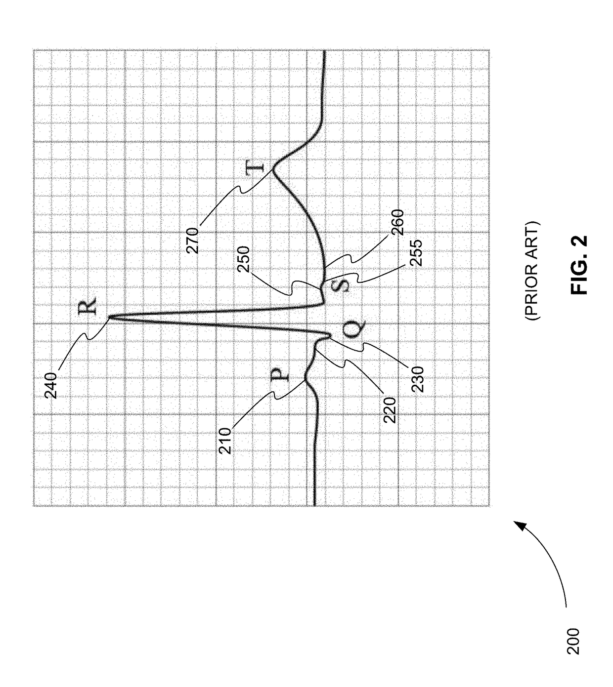 Automated ECG Analysis and Diagnosis System