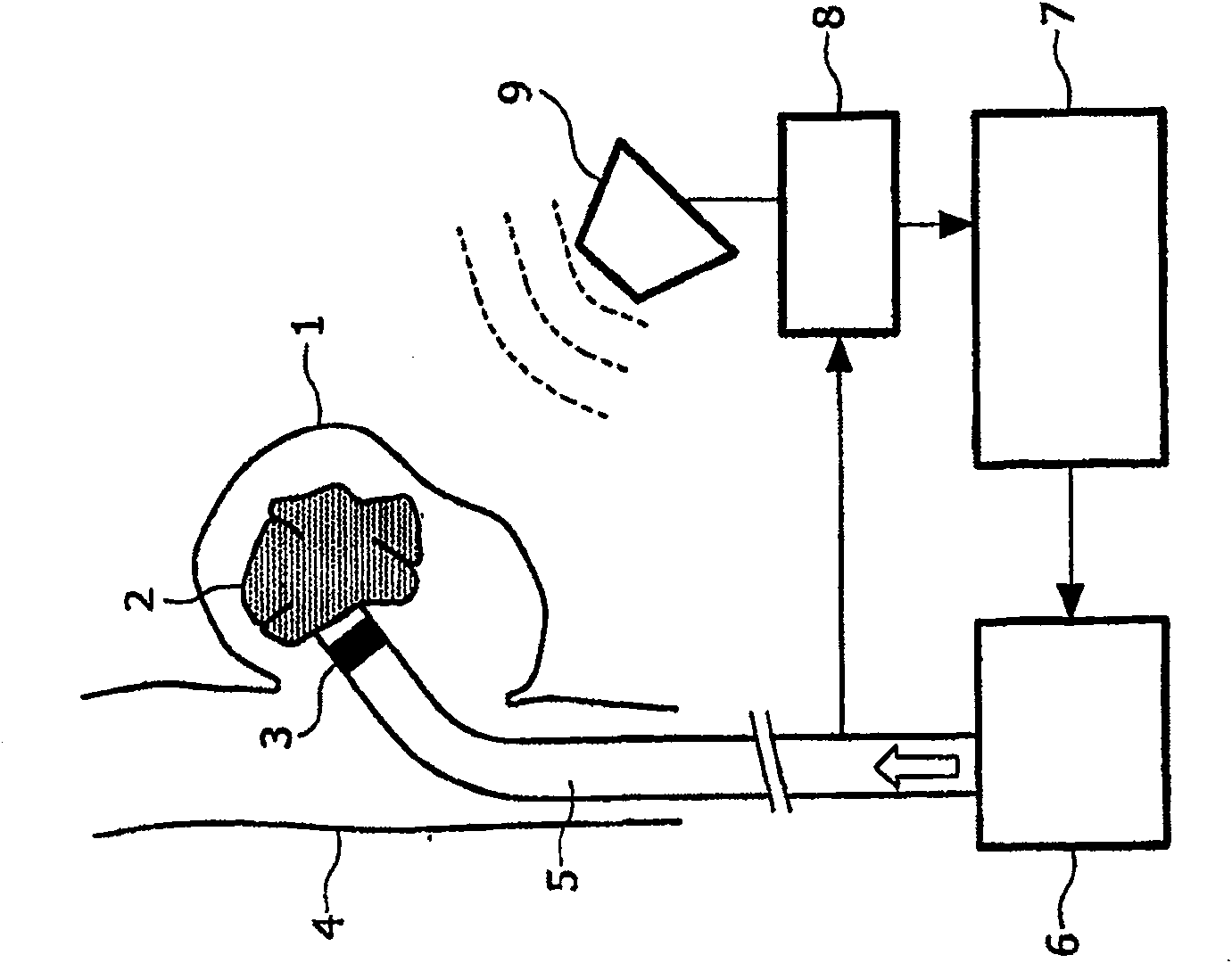 Catheter, apparatus and method for therapeutic embolization