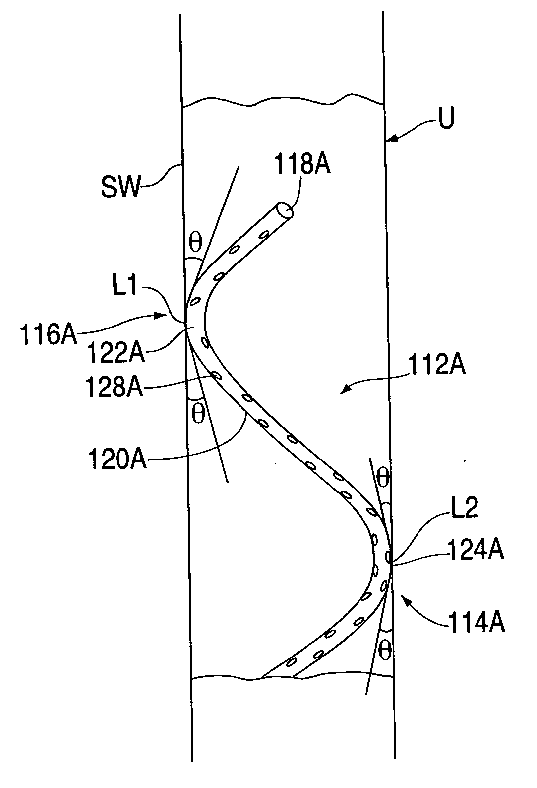 Ureteral stent