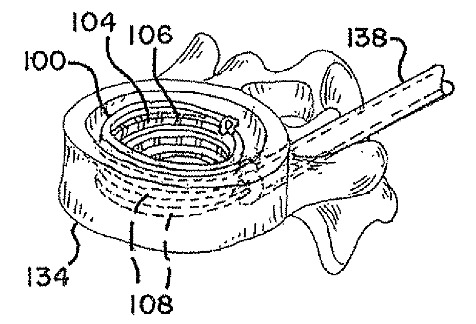 Devices for treating the spine