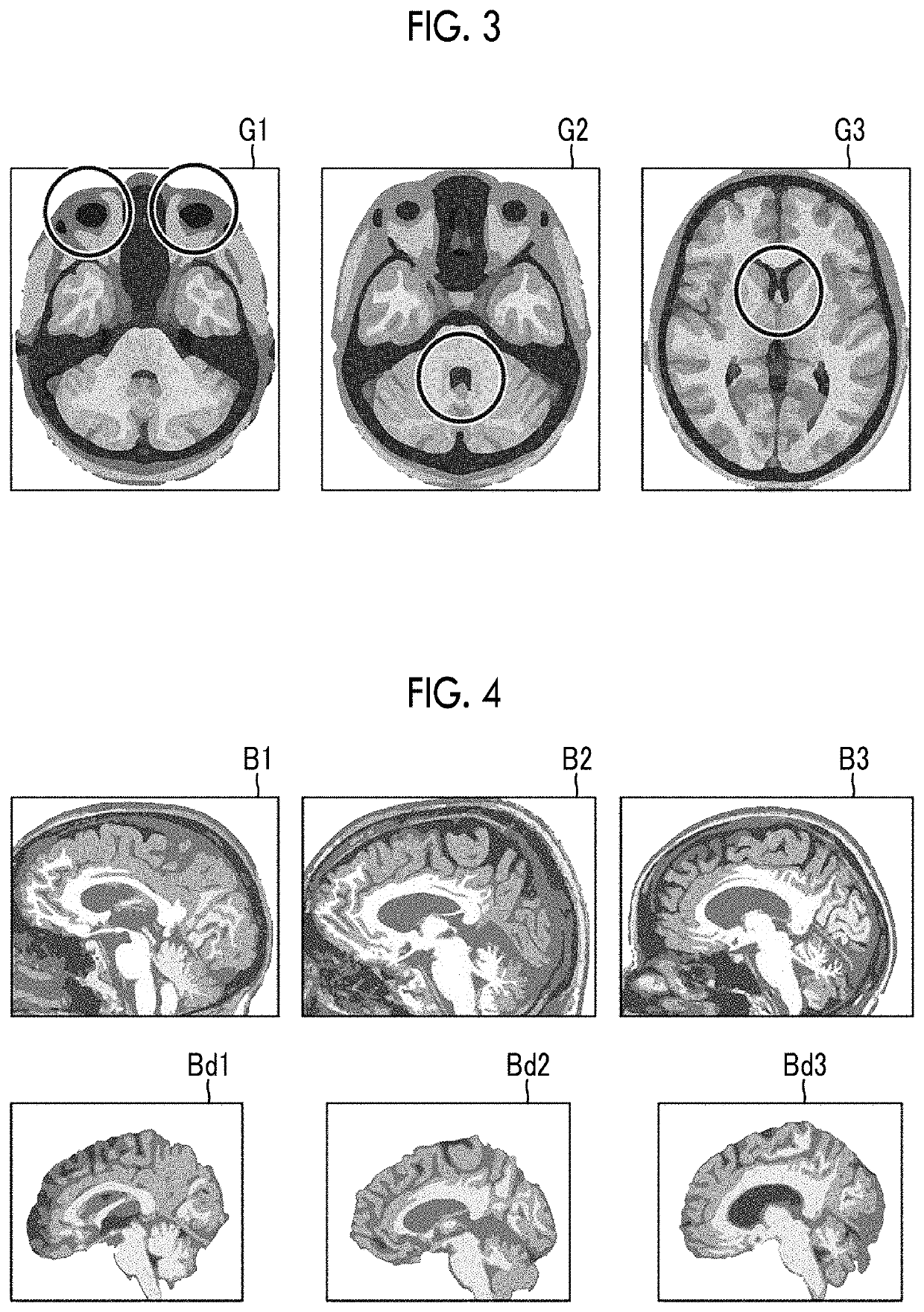 Brain image normalization apparatus, brain image normalization method, and brain image normalization program