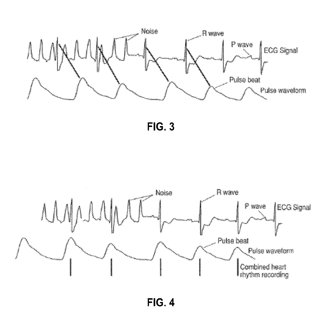 Method and apparatus for detecting atrial fibrillation