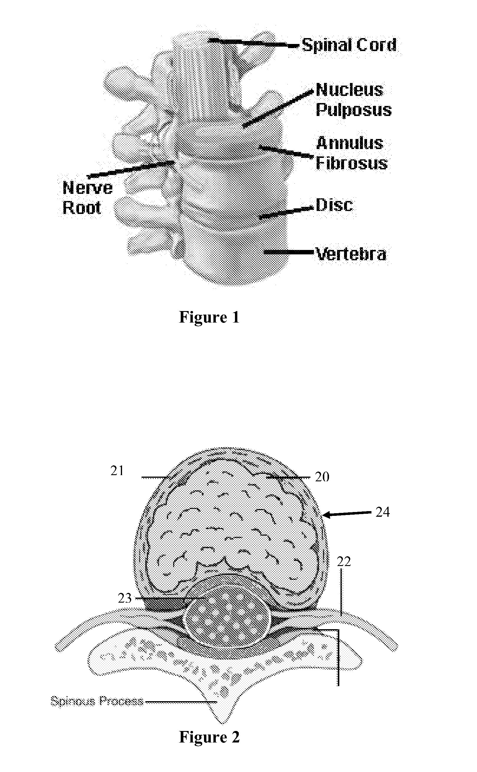 Nucleus Extraction from Spine Intervertebral Disc