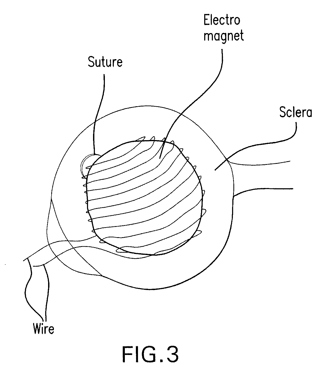 Method and composition for hyperthermally treating cells