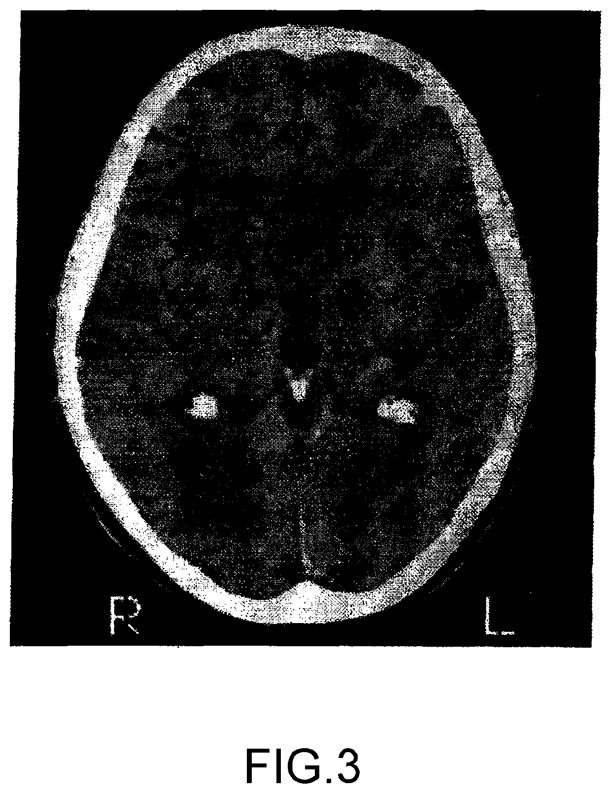 Method and system for reducing the likelihood of a porphyromonas gingivalis infection in a human being