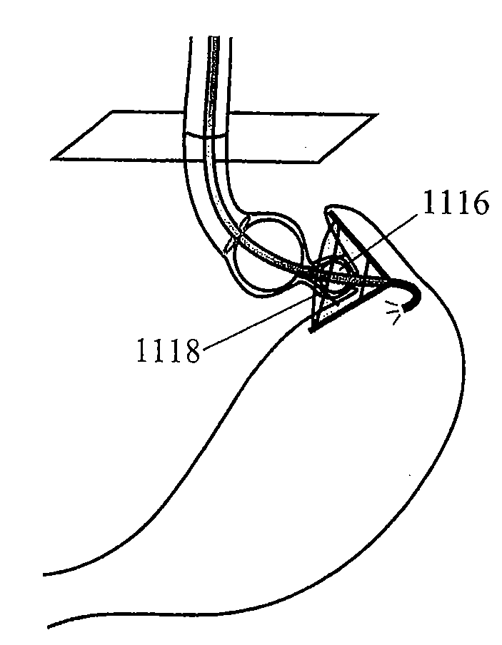 Methods and devices for treating obesity and gerd by intussuscepting a portion of stomach tissue