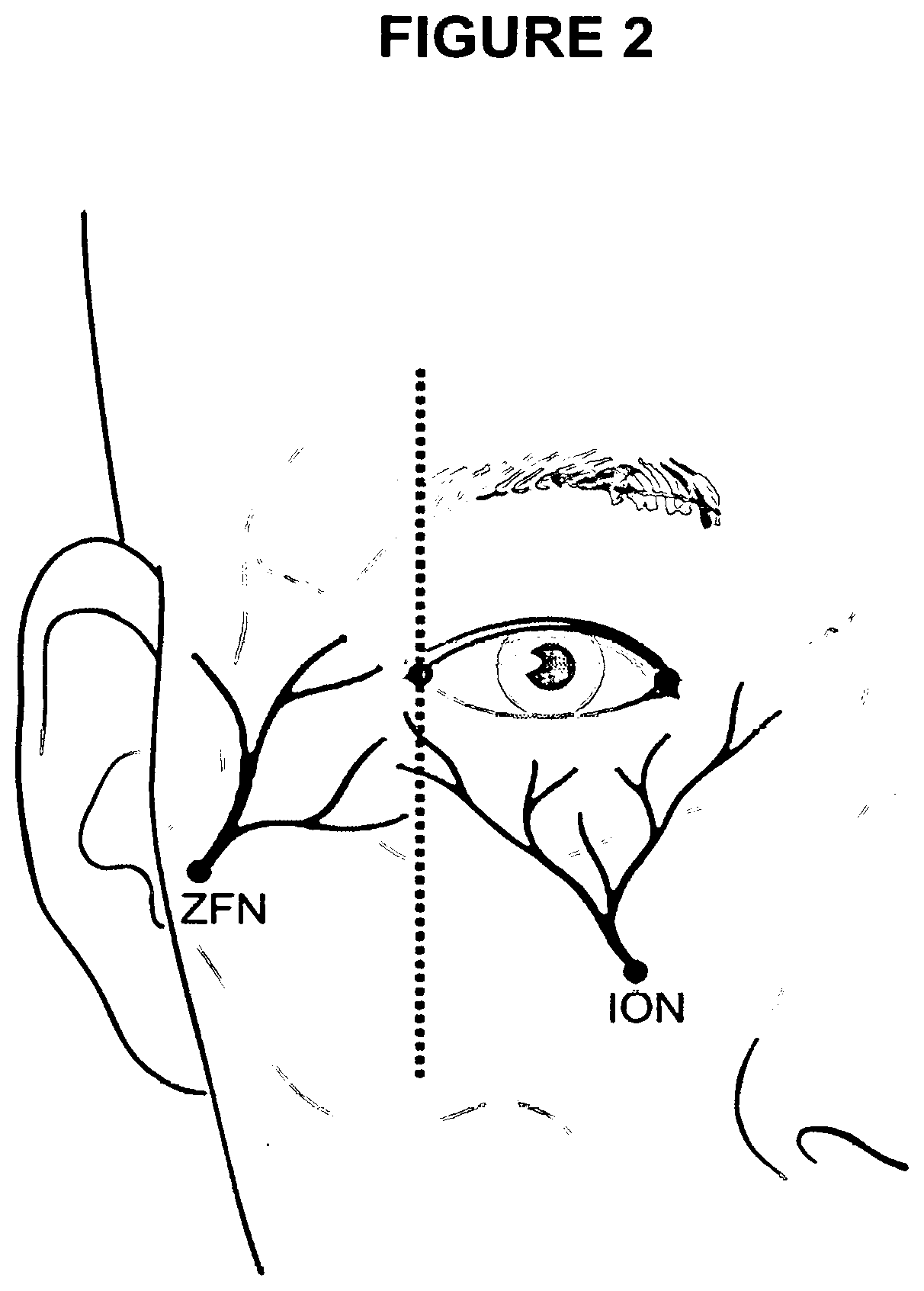 Di-Isopropyl-Phosphinoyl -Alkanes as topical agents for the treatment of sensory discomfort