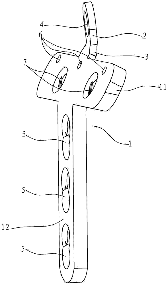 Ulnar coronoid lateral column plate