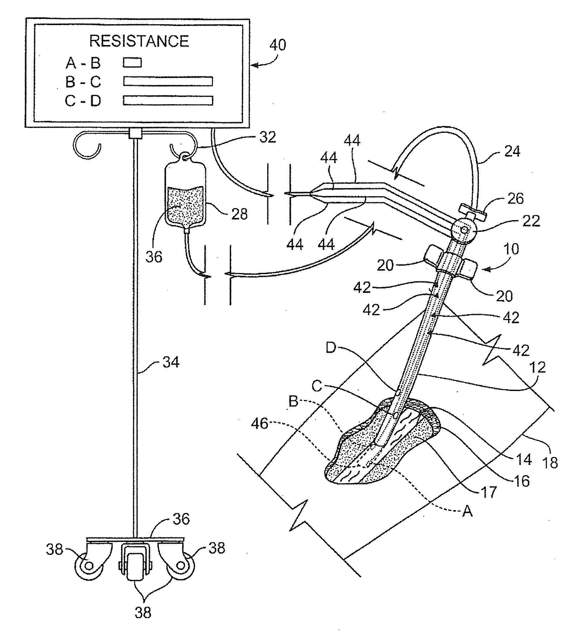 Intravenous apparatus and method