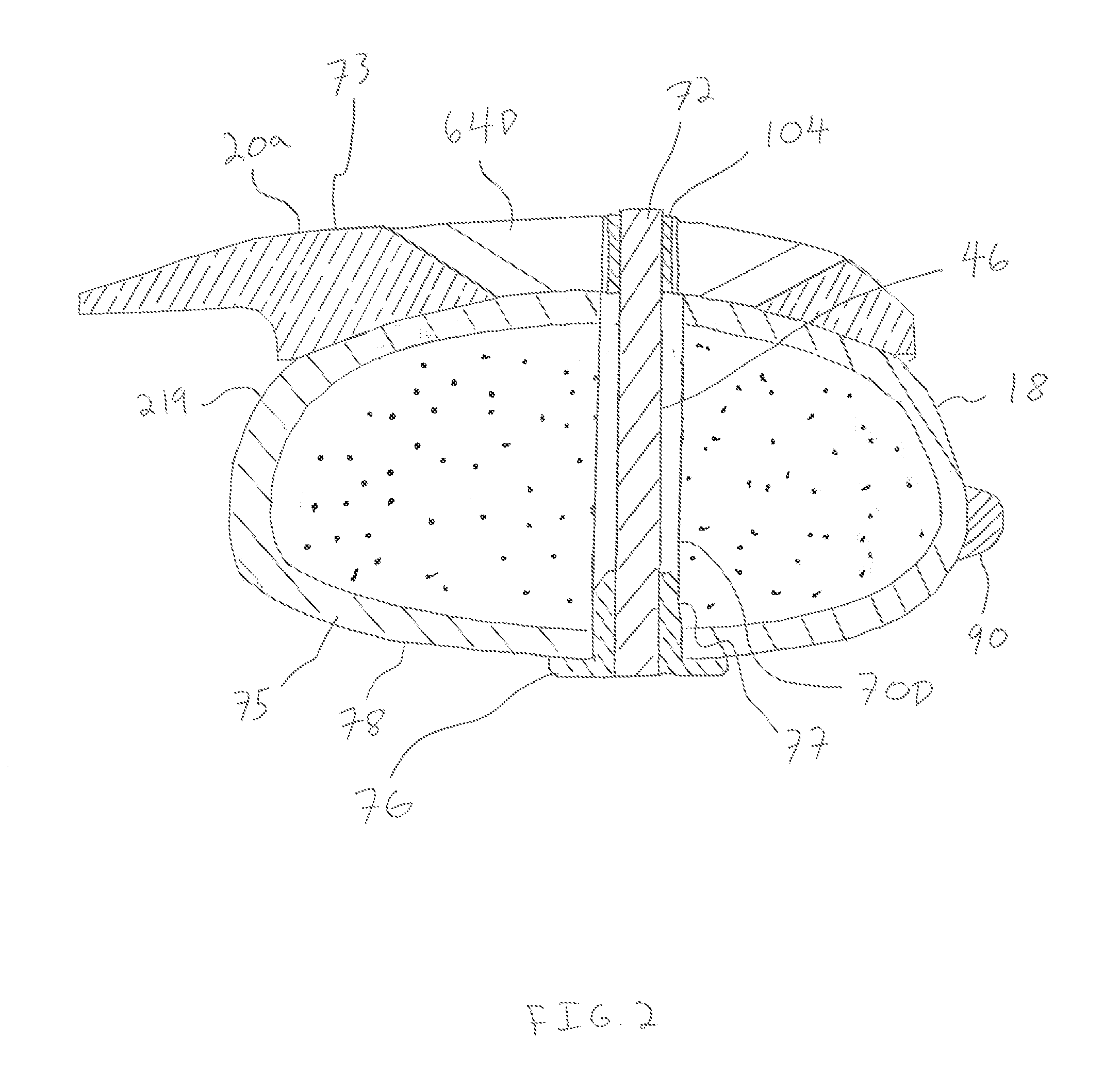 Bone plate system and method