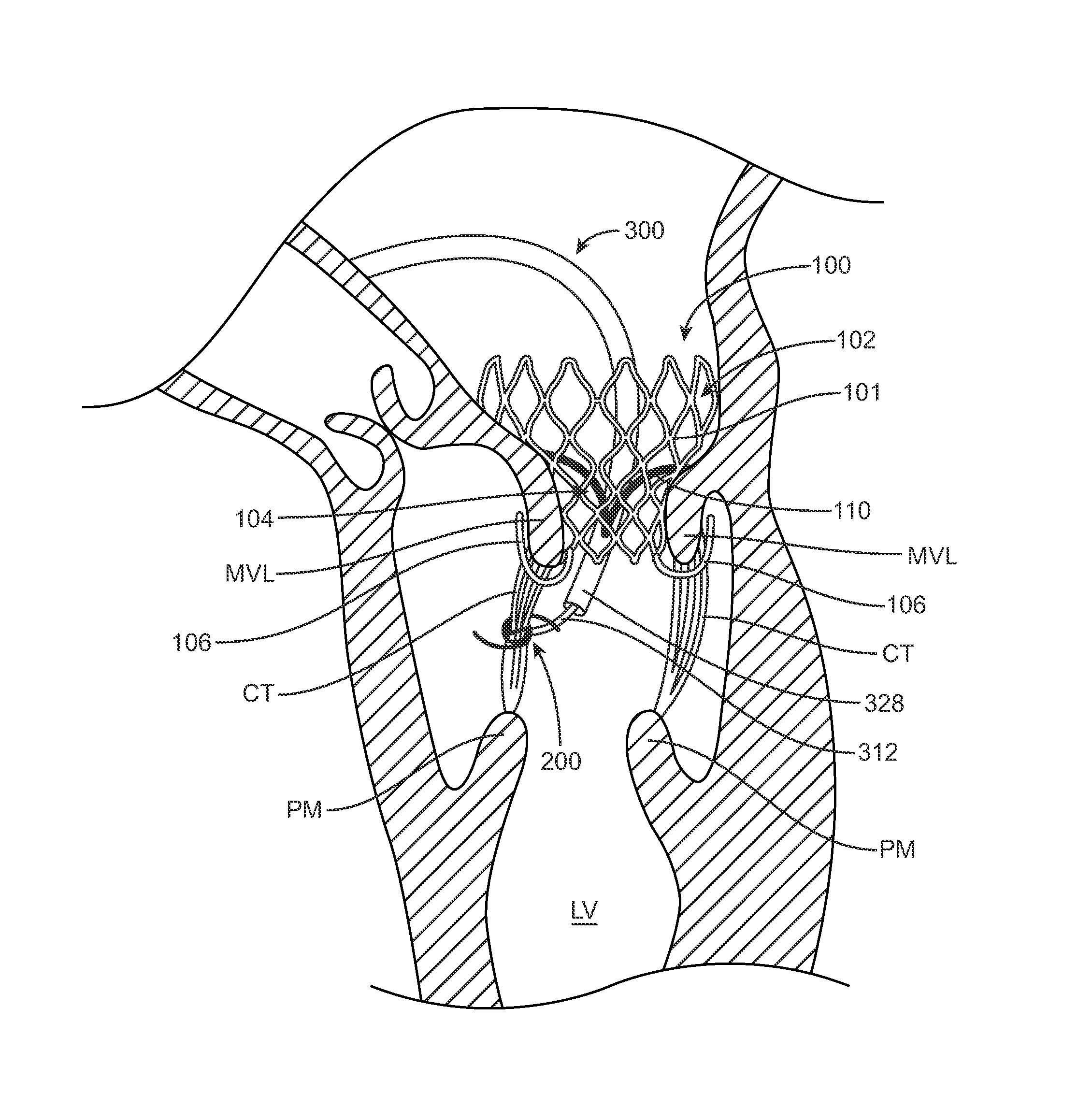 Method of treating paravalvular leakage after prosthetic valve implantation