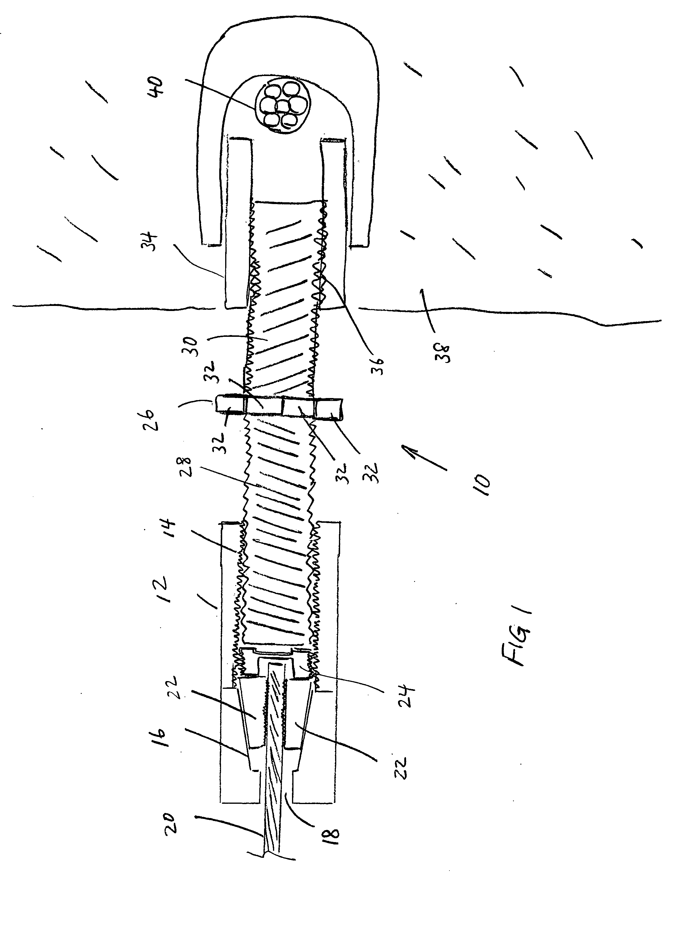 Tensioning anchor suitable for blind-hole tendon anchoring and tendon repair