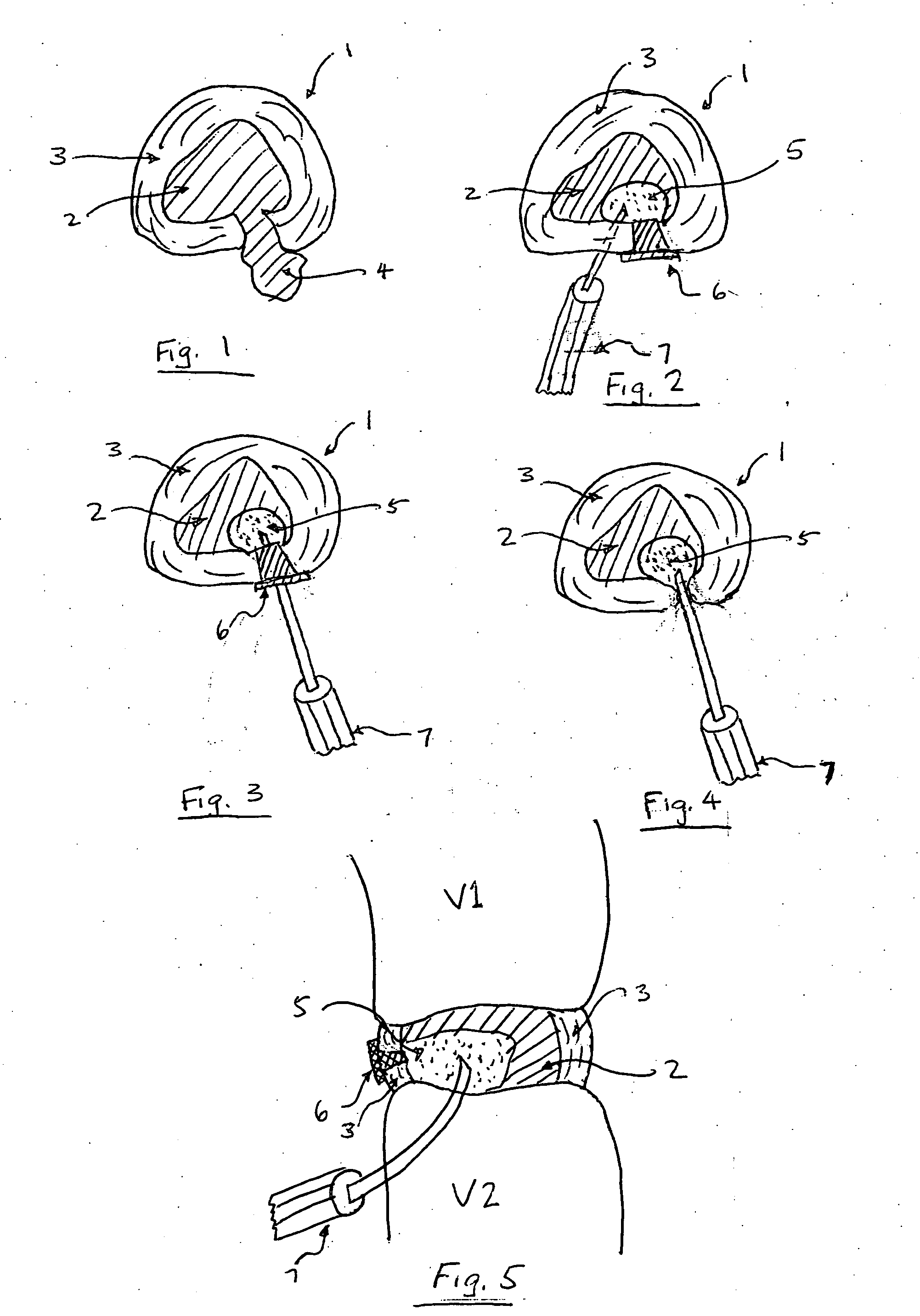 Degenerative disc regeneration techniques