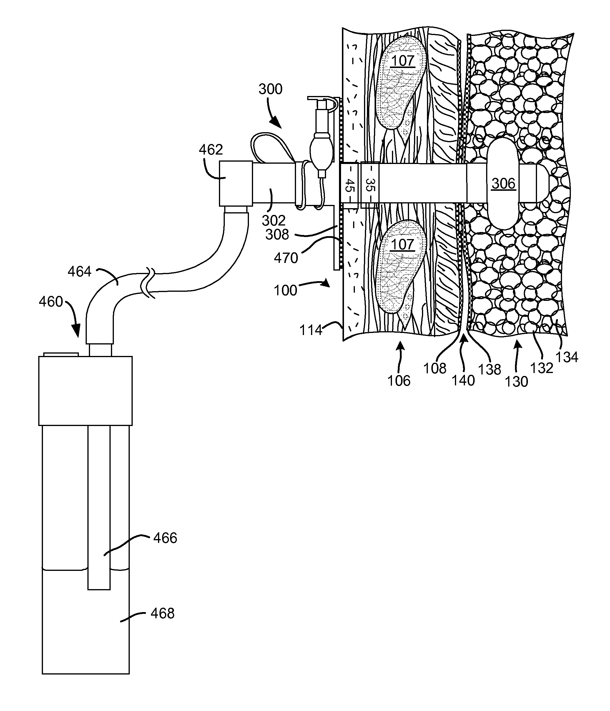 Surgical instruments for creating a pneumostoma and treating chronic obstructive pulmonary disease