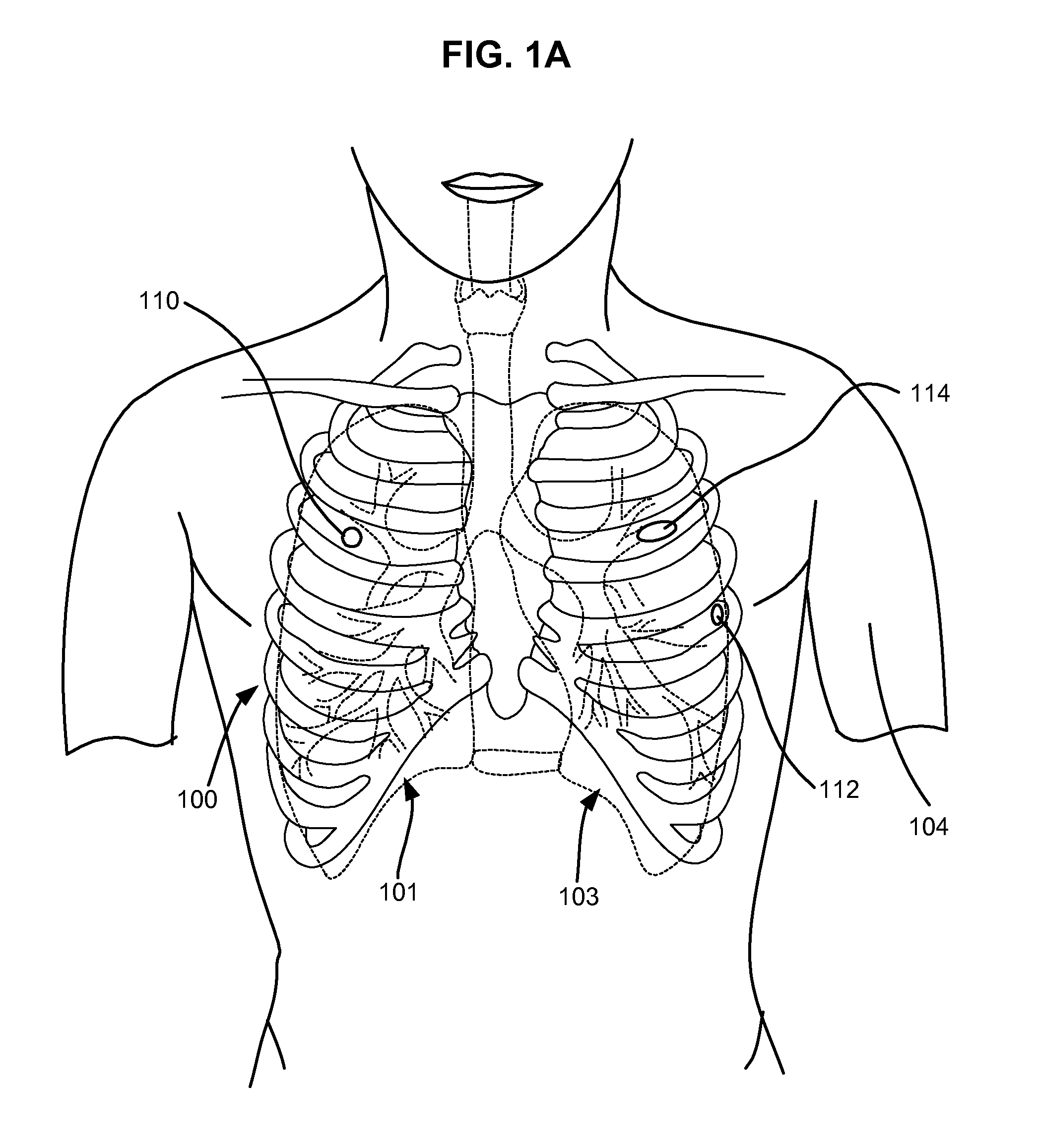 Surgical instruments for creating a pneumostoma and treating chronic obstructive pulmonary disease