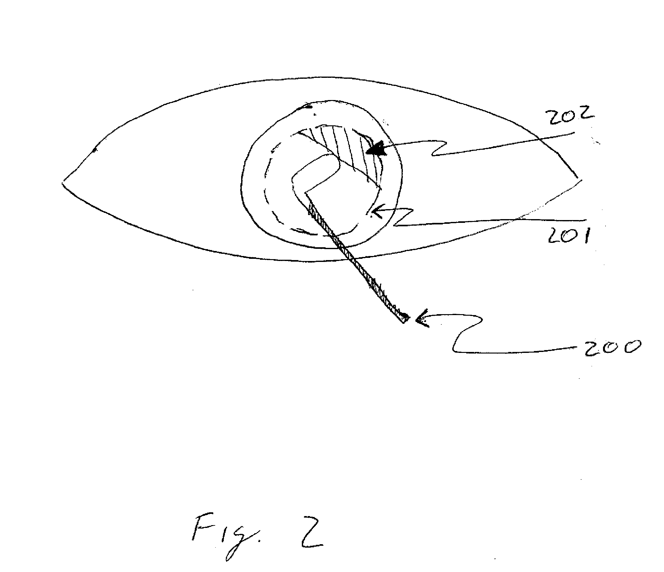 Apparatus and Method for Removing Epithelium from the Cornea