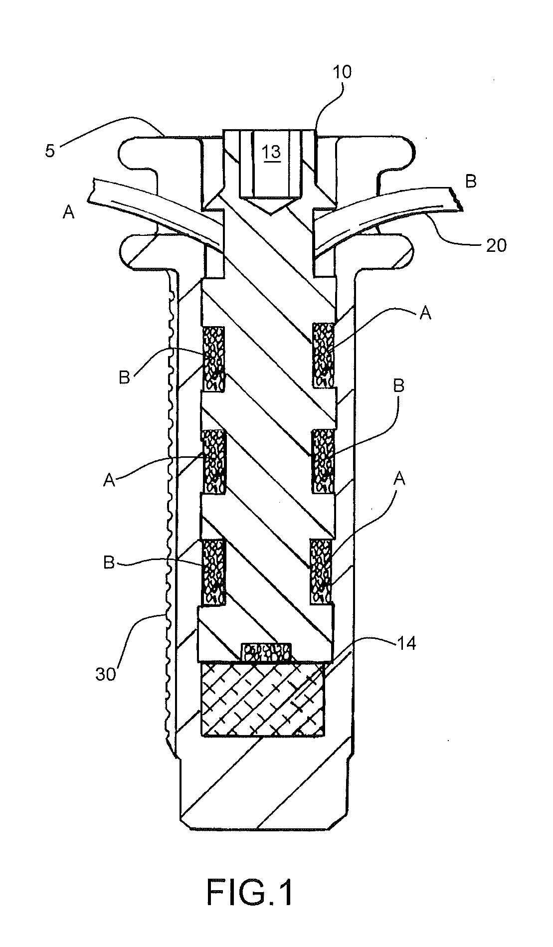 Internal Joint Bracing System and Suture Anchoring Assembly Therefore