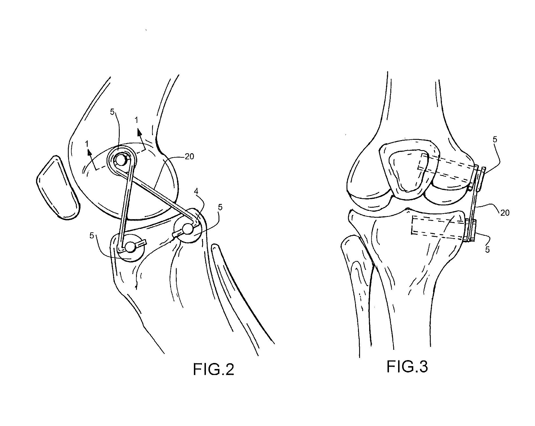 Internal Joint Bracing System and Suture Anchoring Assembly Therefore