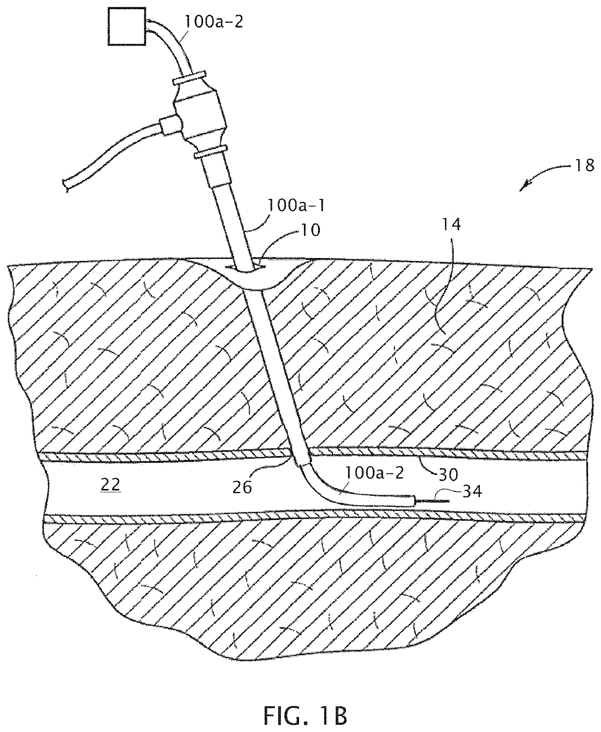 Trapping sheaths and guide catheters