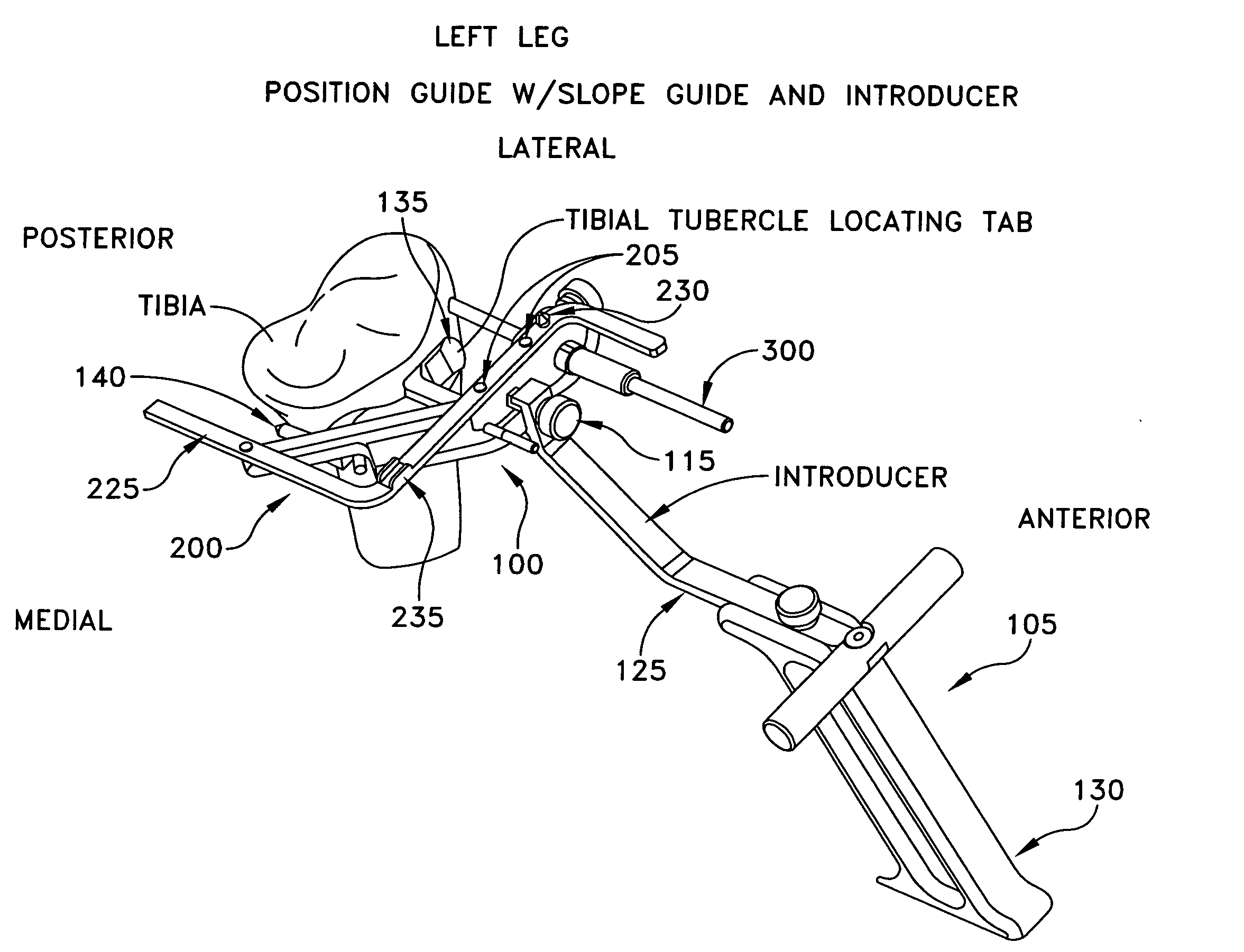 Method and apparatus for performing an open wedge, high tibial osteotomy