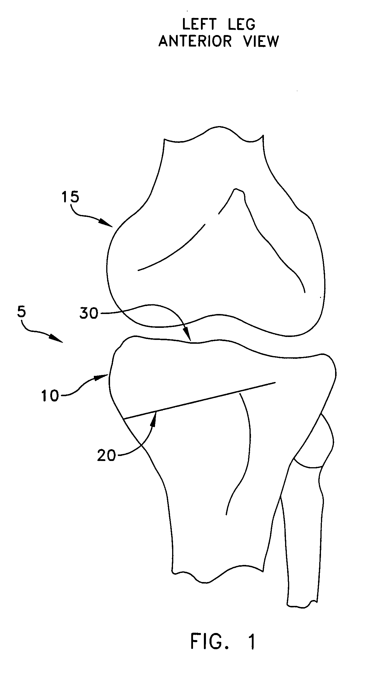 Method and apparatus for performing an open wedge, high tibial osteotomy